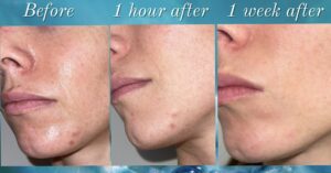 Springs Rejuvenation-Acne one hour to one week
