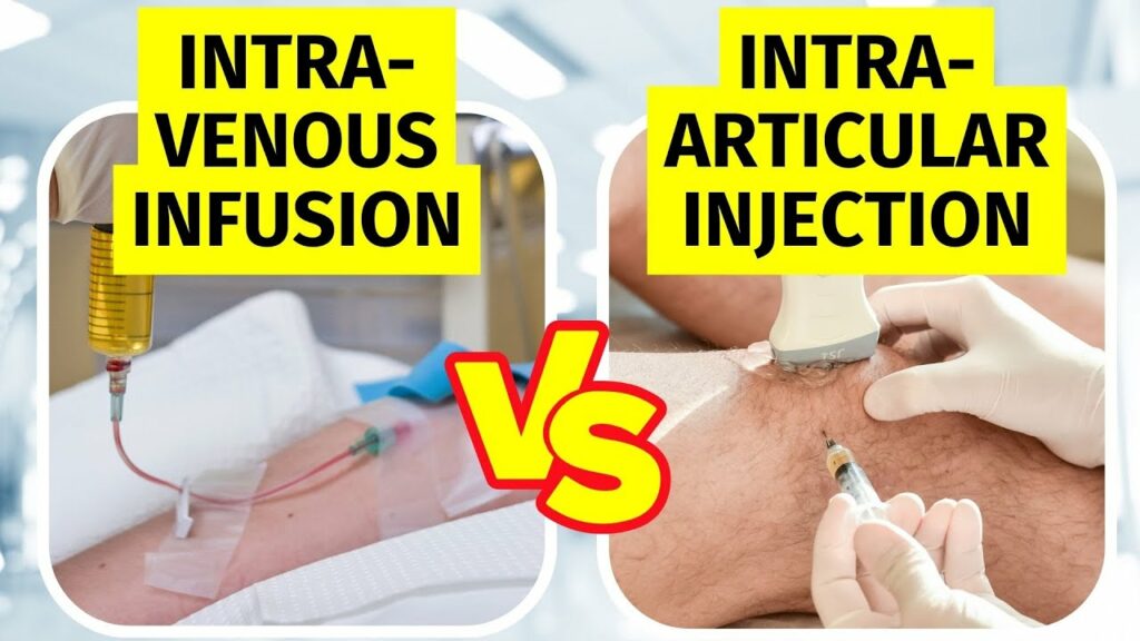 Intravenous (IV) vs Intra-articular Stem Cell Therapy for Knee Arthritis - Dr Jeffrey Peng